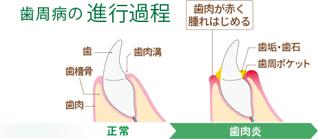 歯周病の進行過程
