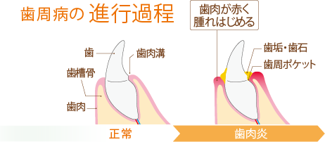 歯周病の進行過程