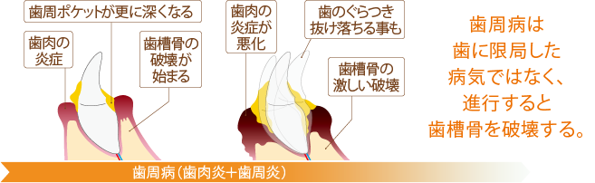 歯周病の進行過程
